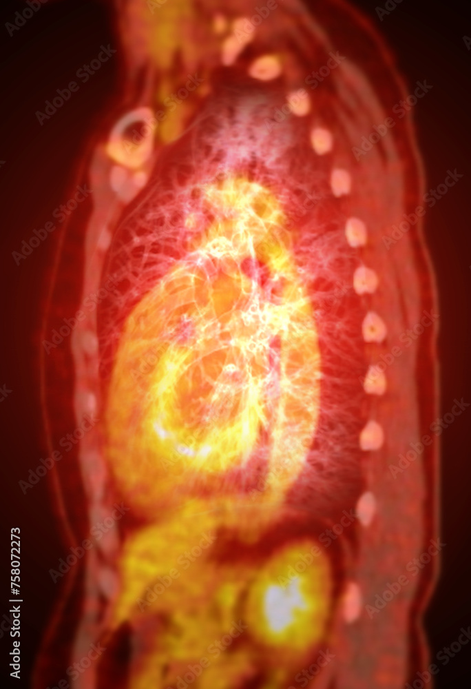 Poster a pet-ct scan image is a diagnostic visualization combining positron emission tomography (pet) and c