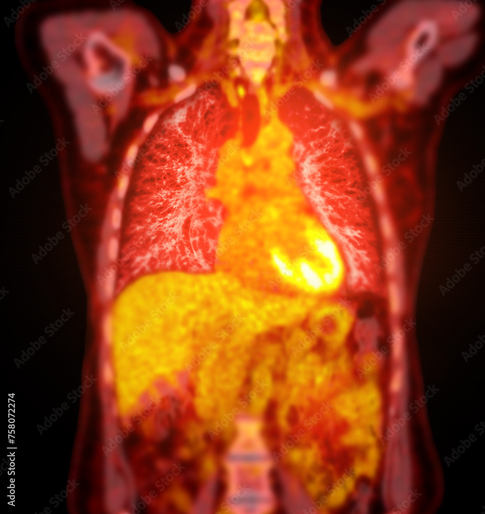 Poster a pet-ct scan image is a diagnostic visualization combining positron emission tomography (pet) and c
