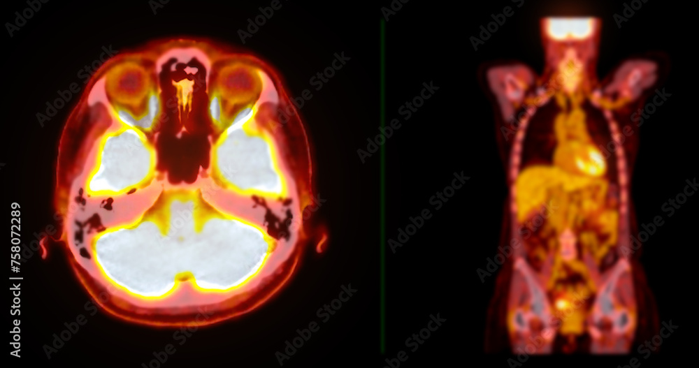 Poster a pet-ct scan image is a diagnostic visualization combining positron emission tomography (pet) and c