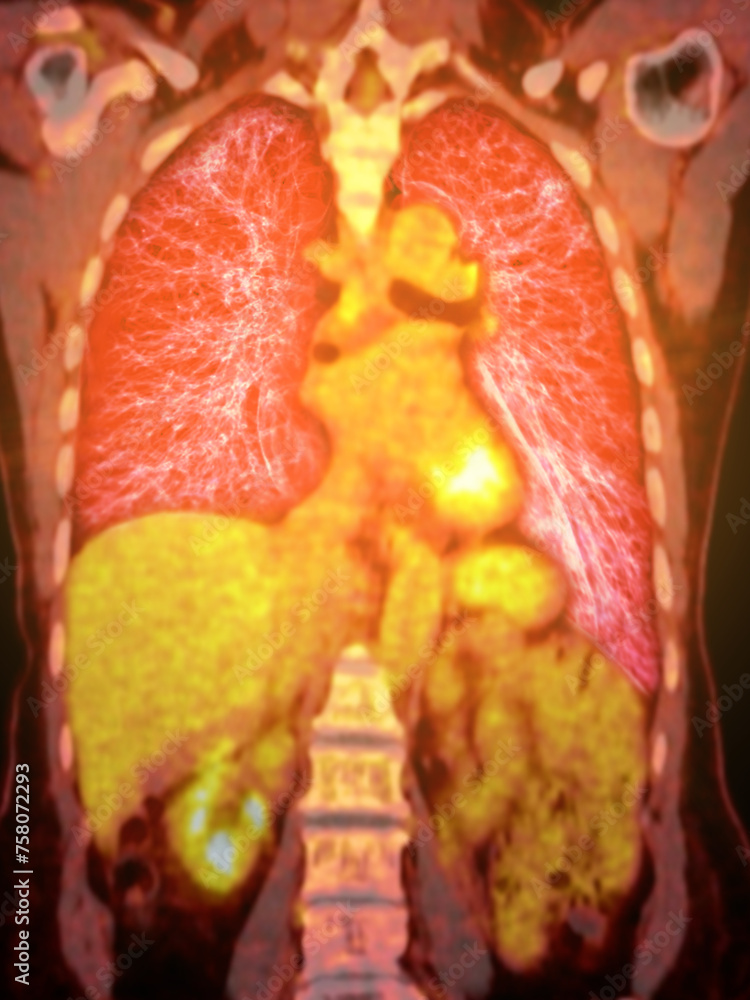 Poster a pet-ct scan image is a diagnostic visualization combining positron emission tomography (pet) and c