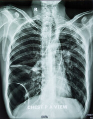 Chest xray of Emphysema 