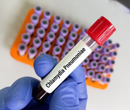 Blood sample for Chlamydia pneumoniae test. STD, STI
