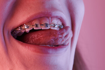 Obraz premium Close-up of a woman's mouth with braces on her teeth