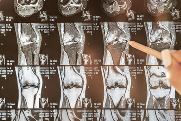 Knee joint x-ray or MRI. Doctor pointed on area of knee joint, where pathology or problem is...