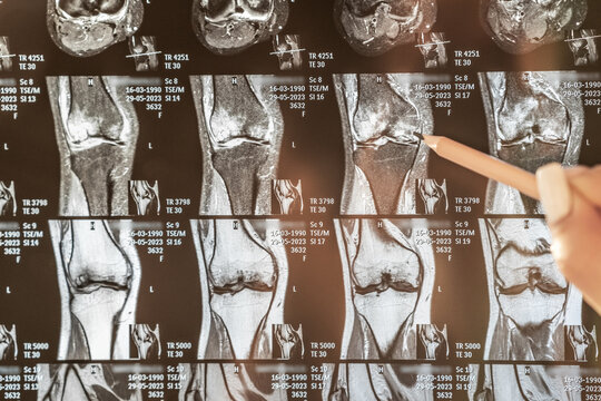 Knee joint x-ray or MRI. Doctor pointed on area of knee joint, where pathology or problem is detected, such fracture, destruction of joint, osteoarthritis, magnetic resonance enterography.
