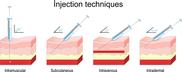 Injection methods. intramuscular, subcutaneous, intravenous, and intradermal injections.