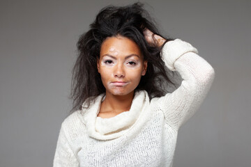 Fototapeta premium Confident black woman with Vitiligo disease looking at camera. Portrait of African American lady with hand in hair standing against gray background. Girl with pigmentation skin problem.