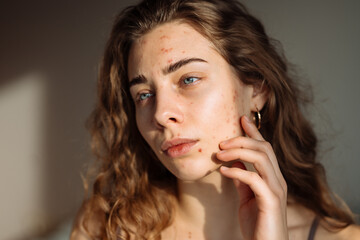 Fototapeta premium Portrait of a young girl with problem skin. Pimples on the face. Facial skin care. Acne problem.
