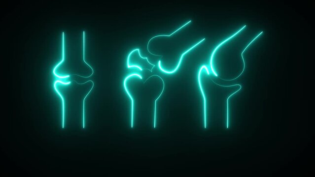 This isa synovial joint. This joint is consisted of femur and tibia. It has synovial cavity which contains synovial fluid.