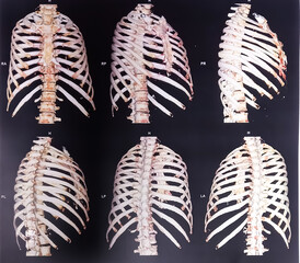 3D CT scan Bony thorax, Multiple fractures are present. Sternal bone fractures with bilateral...
