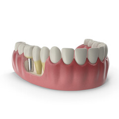 Educational Lower Teeth Medical Model Featuring a Dental Implant - Detailed Representation for Dental Learning.