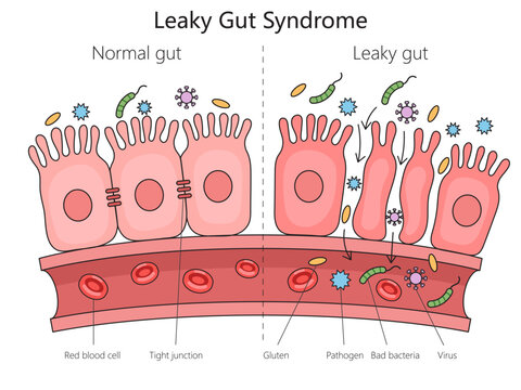 normal gut and leaky gut syndrome with labeled elements like bacteria and tight junctions structurediagram hand drawn schematic vector illustration. Medical science educational illustration