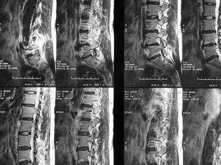 MRI scan of lumbar spine
