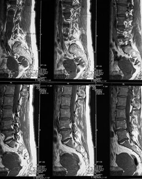 MRI scan of lumbar spine