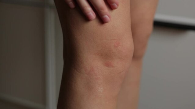 Allergic rash dermatitis eczema on woman leg. Female runs hand along knee with red rash caused by insect bites. Dermatitis, folliculitis, fungal infection. Affected area of skin to turn red, to swell.