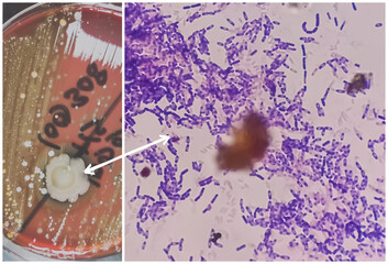 Yeast Infection; Budding yeast and pseudohyphae of Candida albicans, gram's stain. This fungus...