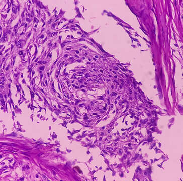 Nipple (biopsy): Invasive squamous cell carcinoma of nipple. microscopic image show malignant neoplasm. Male nipple cancer. Paget's disease of the nipple.