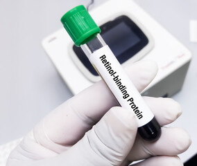 Blood sample for Retinol Binding Protein (RbP) testing which is used to assess renal tubular injury or dysfunction.