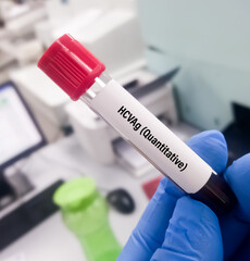 Technologist holding blood sample for Hepatitis C virus (HCV) antigen testing, anti-hcv.