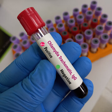 Blood sample for Chlamydia antibodies, IgG test. STD, STI