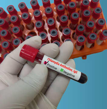 Blood sample for Chlamydia antibodies, IgG test. STD, STI