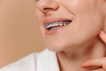 Obraz premium Close-up of a woman with braces on a beige background