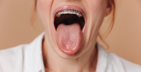Close-up of a woman showing her tongue and braces on her teeth