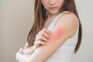 Dermatology asian young woman, girl allergy, allergic reaction from atopic, insect bites on arm, hand in scratching itchy, itch red spot or rash of skin. Healthcare, treatment of beauty on background.