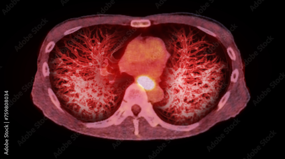 Poster ct chest or lung 3d rendering image showing trachea and lung in respiratory system..