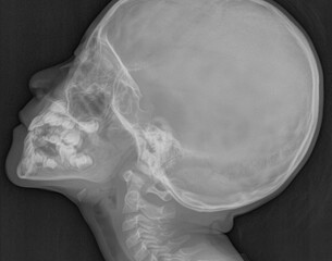 adenoid enlargement  , Skull lateral soft tissues X ray
