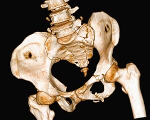 3D CT scan of the skeleton of a patient with a fractured pelvis
