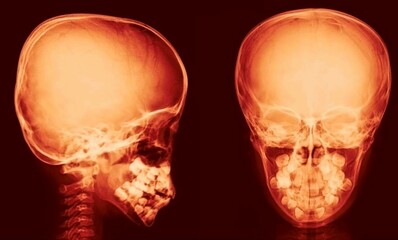 normal skull x ray  anterior and lateral view 
