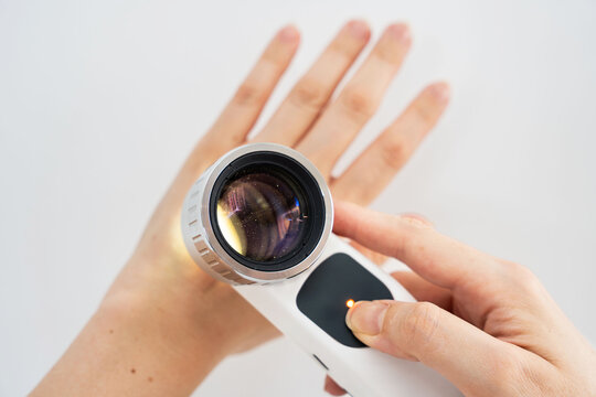 Overhead image of hands are using a dermatoscope to examine nevi (moles) on the surface of a hand against a white background showing the importance of skin examinations for early detection of melanoma