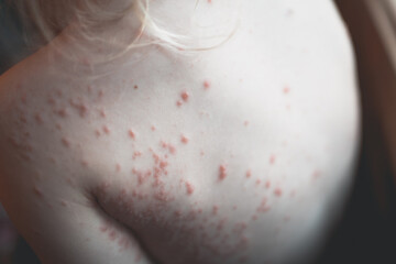 2 year old with severe chickenpox across body