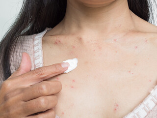 Woman with Urticaria Allergy Itchy Rash Eczema Itch Neck from Food,Air...