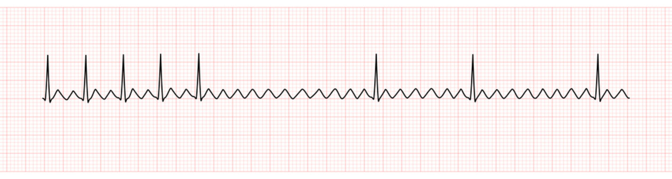 EKG Monitor Showing  Atrial Flutter with 2:1 AV Block After Adenosine Intravenous