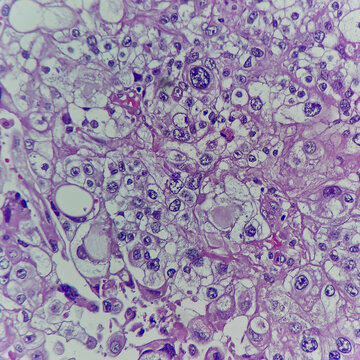 Camera photo of clear cell type of endometrial carcinoma, showing pleomorphic nuclei and clear cytoplasm, magnification 400x, photograph through a microscope