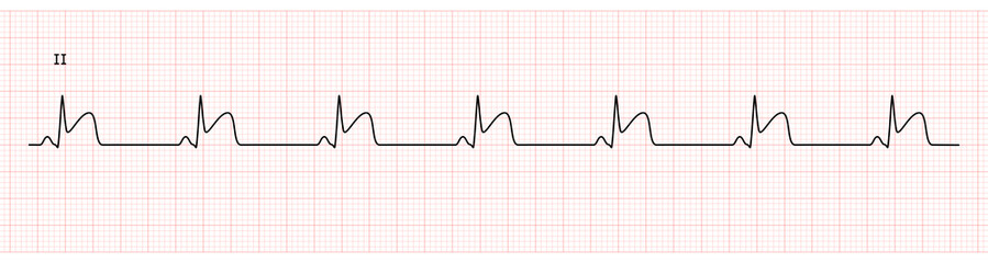 EKG Monitor in lead II Showing  Sinus Rhythm with STEMI at Inferior Wall