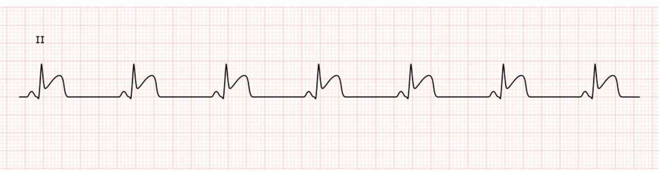 EKG Monitor in lead II Showing  Sinus Rhythm with STEMI at Inferior Wall