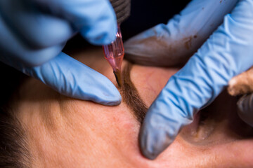 acupuncture needles on a foot