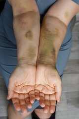Woman hand with car accident bruise