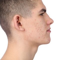 Young man with acne problem isolated on white