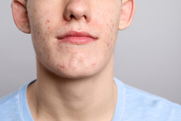 Young man with acne problem on grey background, closeup