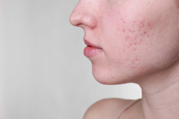 Young woman with acne problem on light grey background, closeup. Space for text