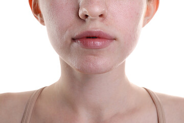 Young woman with acne problem on white background, closeup