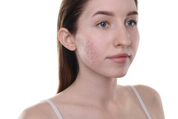 Young woman with acne problem on white background