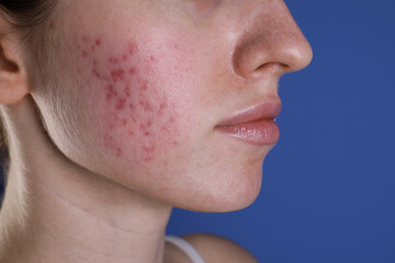 Young woman with acne problem on blue background, closeup