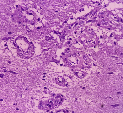 Kidney cancer: Microscopic image of metastatic clear cell carcinoma of kidney, the most common type of renal cell carcinoma. Show brain tissue of malignant neoplasm, large atypical bizarre cells.
