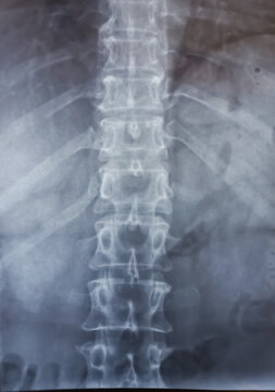 x ray image of human dorsal lumber spine ap view. Early degenerative changes.