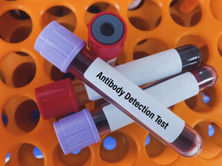 Blood sample for Antibody detection test, diagnosis of hemolytic anemia or hemolytic disease....